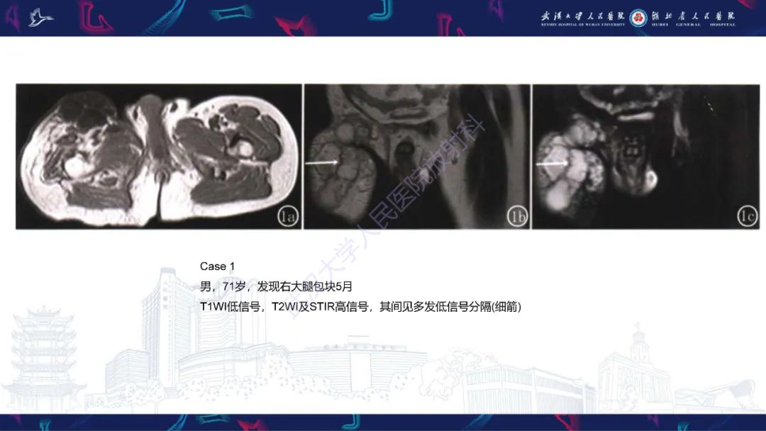 影像PPT - 【PPT】骨外粘液样软骨肉瘤影像诊断-12