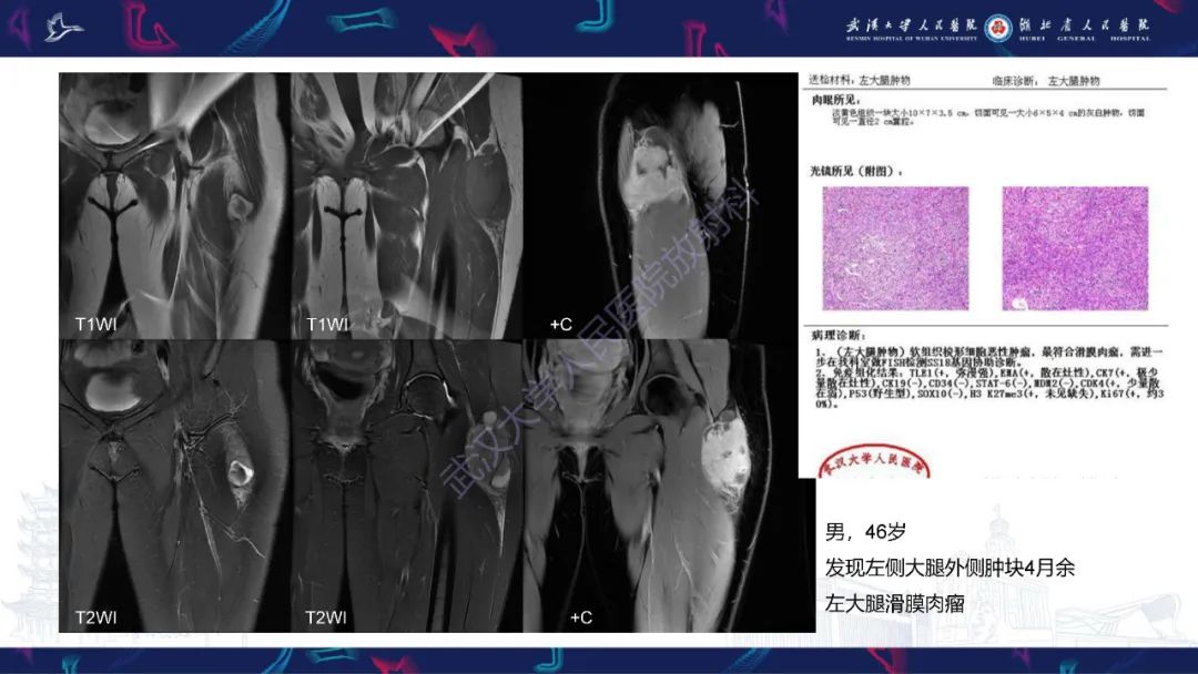影像PPT - 【PPT】骨外粘液样软骨肉瘤影像诊断-18