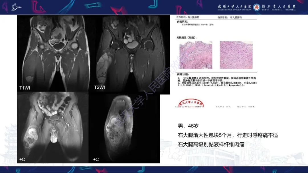 影像PPT - 【PPT】骨外粘液样软骨肉瘤影像诊断-20