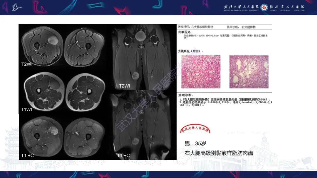 影像PPT - 【PPT】骨外粘液样软骨肉瘤影像诊断-23