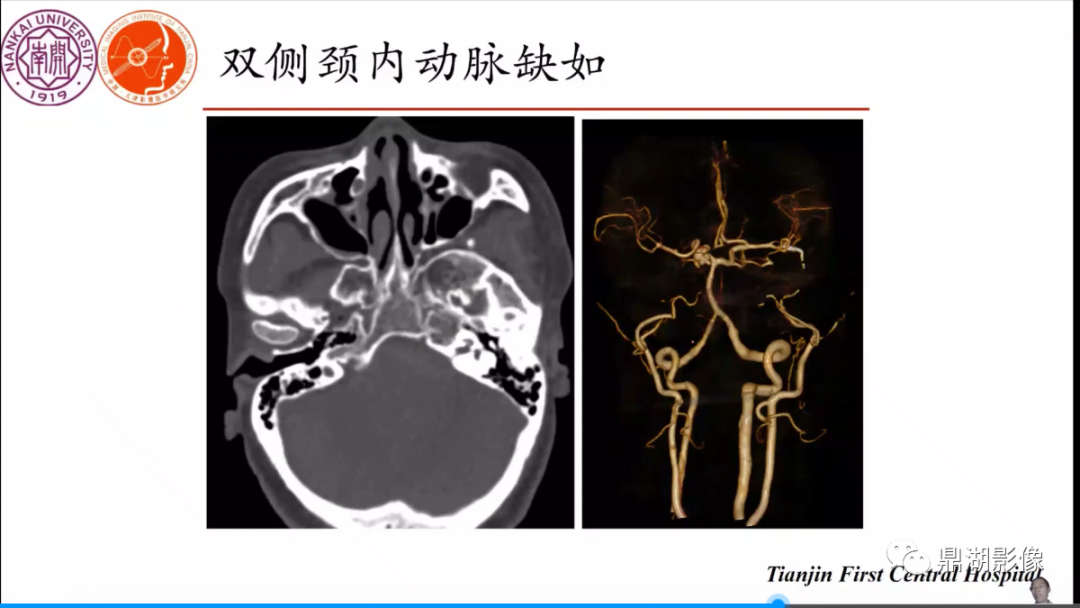 影像PPT - 【病例】双侧颈内动脉缺如1例CT-1 影像PPT - 【病例】双侧颈内动脉缺如1例CT-1