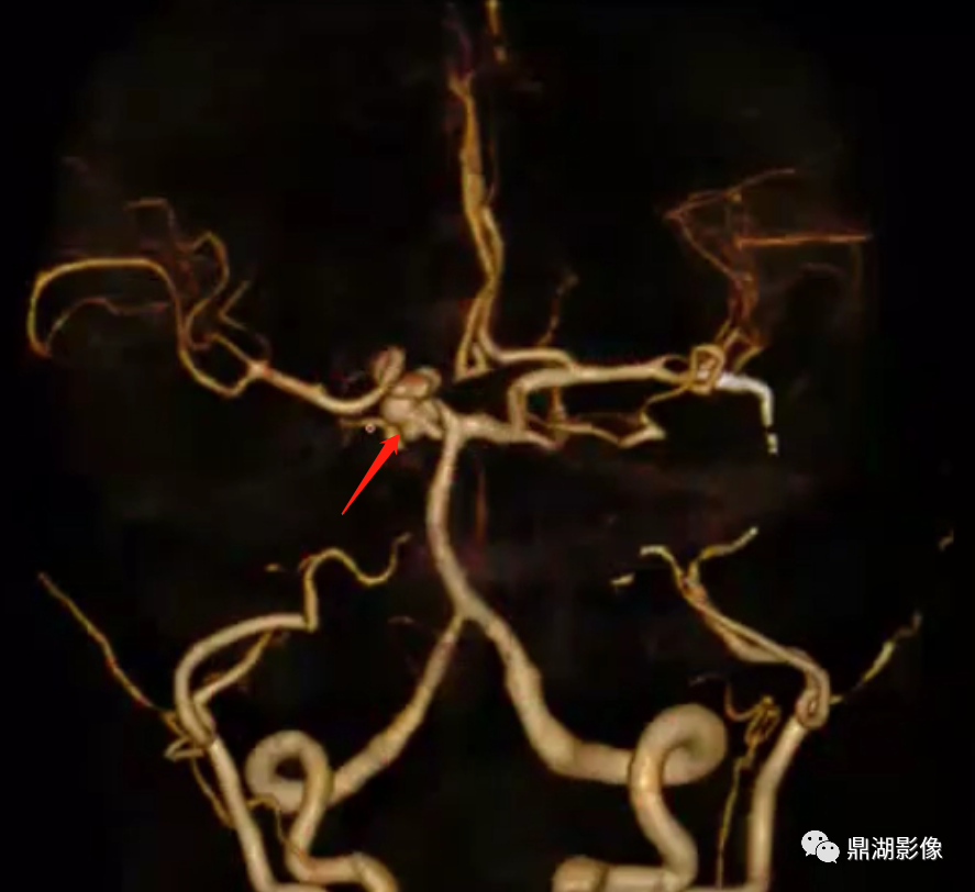 影像PPT - 【病例】双侧颈内动脉缺如1例CT-2 影像PPT - 【病例】双侧颈内动脉缺如1例CT-2