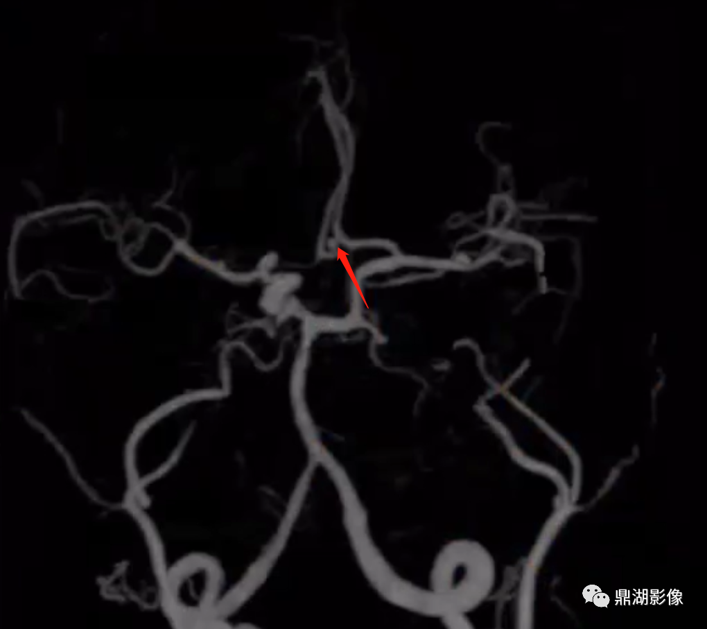 影像PPT - 【病例】双侧颈内动脉缺如1例CT-5 影像PPT - 【病例】双侧颈内动脉缺如1例CT-5