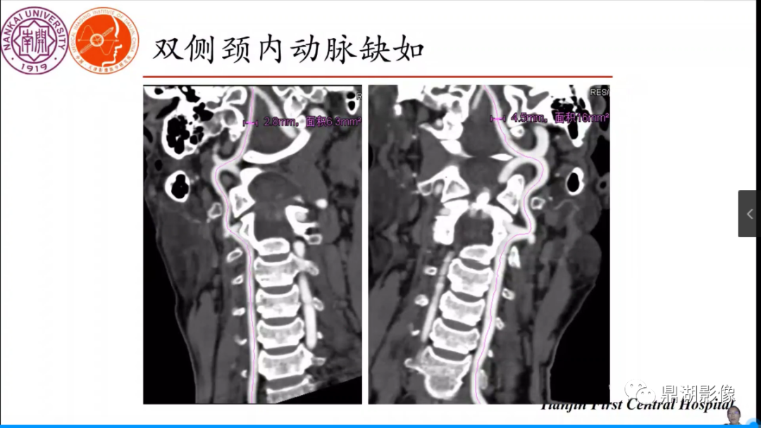 影像PPT - 【病例】双侧颈内动脉缺如1例CT-7 影像PPT - 【病例】双侧颈内动脉缺如1例CT-7