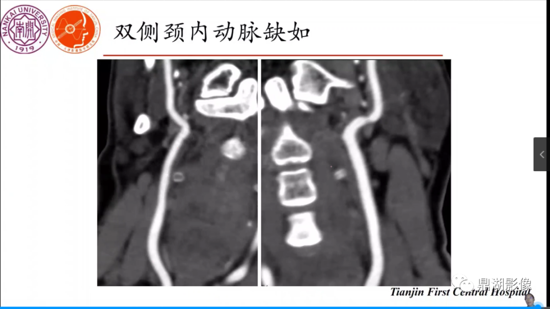 影像PPT - 【病例】双侧颈内动脉缺如1例CT-6 影像PPT - 【病例】双侧颈内动脉缺如1例CT-6