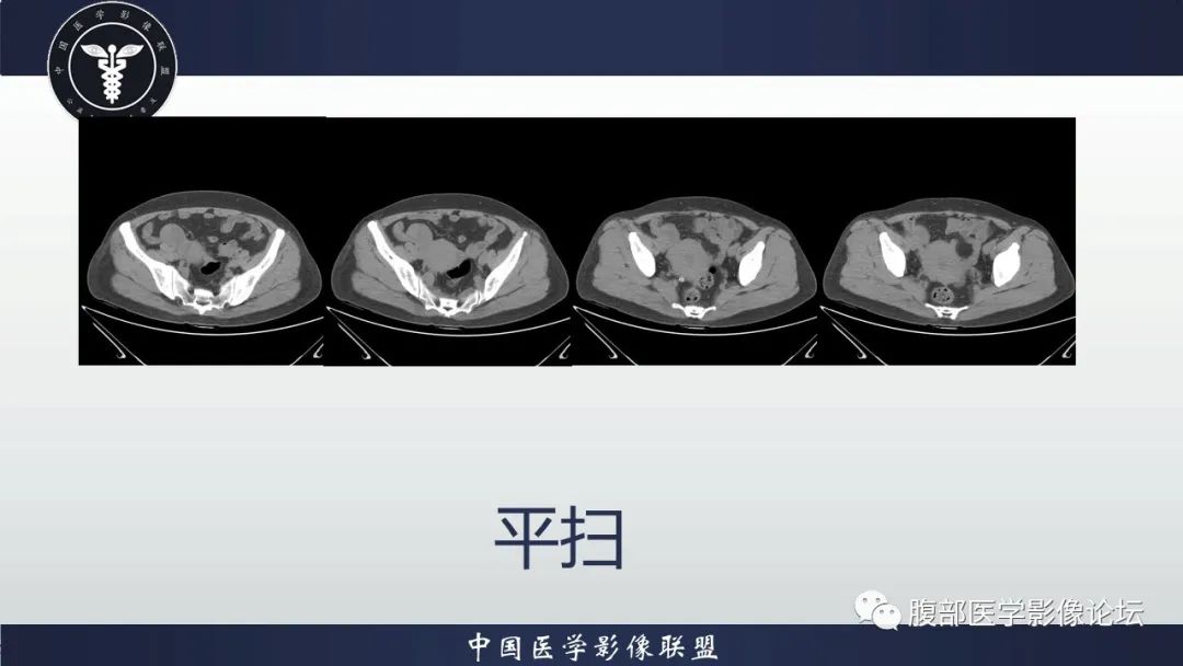 影像PPT - 【病例】卵巢颗粒细胞瘤3例影像-10