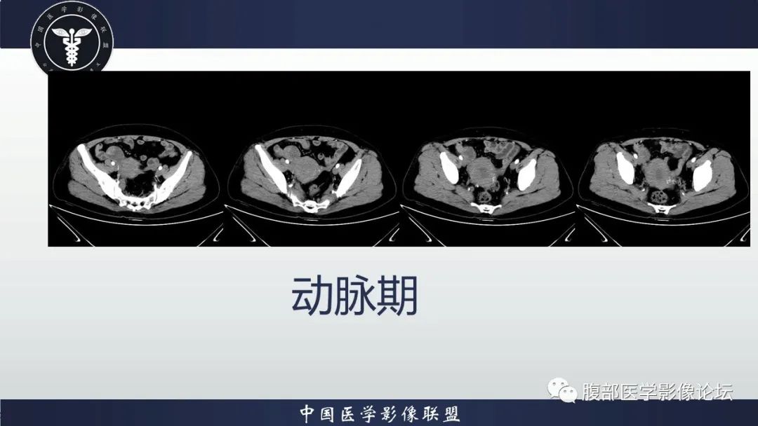 影像PPT - 【病例】卵巢颗粒细胞瘤3例影像-11