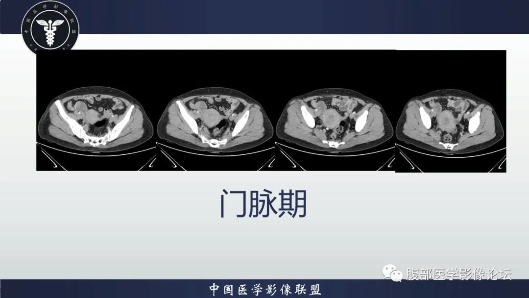影像PPT - 【病例】卵巢颗粒细胞瘤3例影像-12