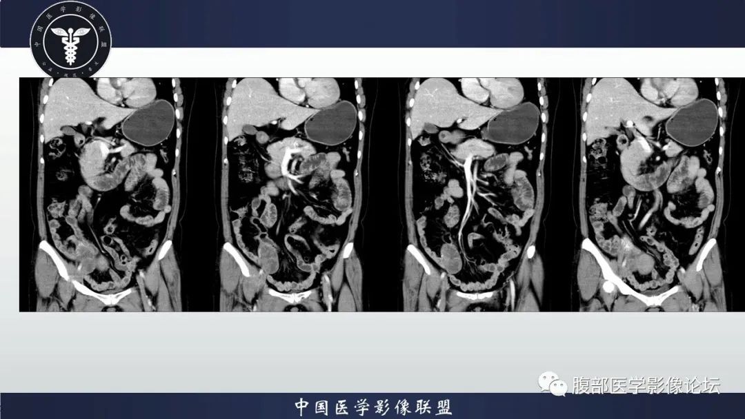 影像PPT - 【病例】卵巢颗粒细胞瘤3例影像-14