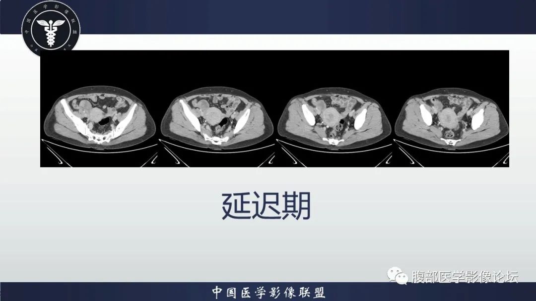 影像PPT - 【病例】卵巢颗粒细胞瘤3例影像-13