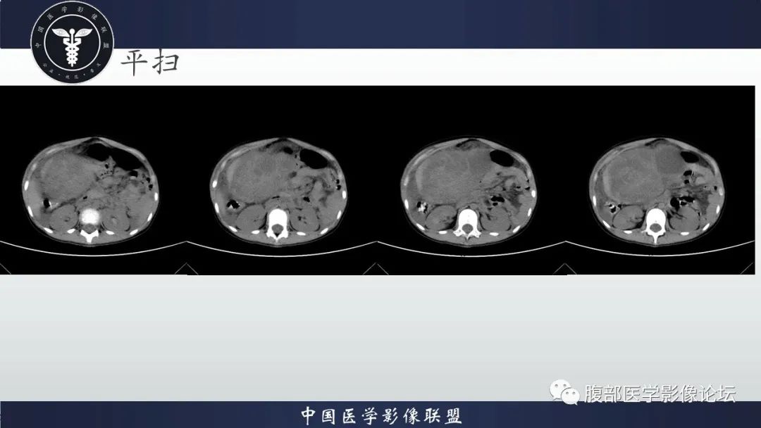 影像PPT - 【病例】卵巢颗粒细胞瘤3例影像-17