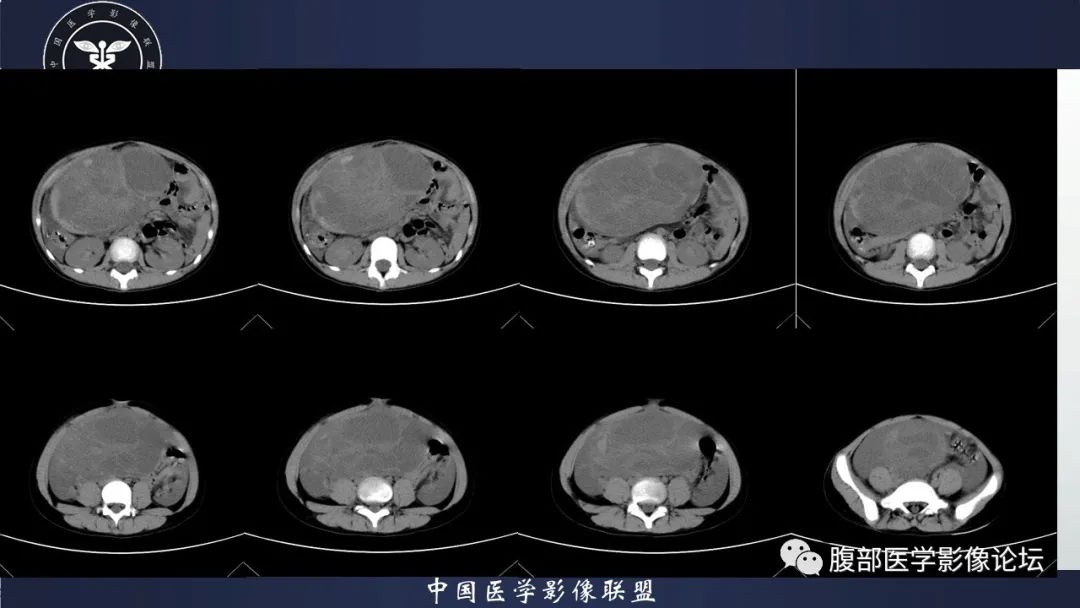 影像PPT - 【病例】卵巢颗粒细胞瘤3例影像-18