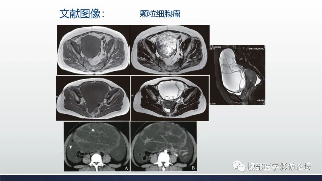 影像PPT - 【病例】卵巢颗粒细胞瘤3例影像-21