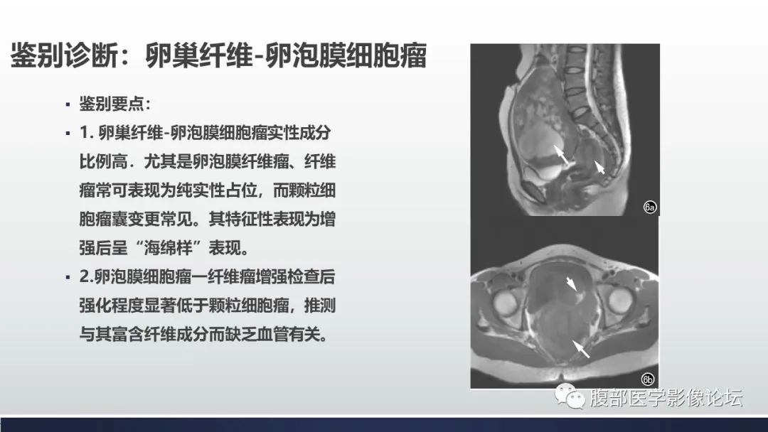 影像PPT - 【病例】卵巢颗粒细胞瘤3例影像-22