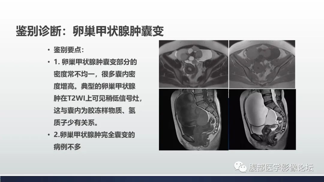 影像PPT - 【病例】卵巢颗粒细胞瘤3例影像-23