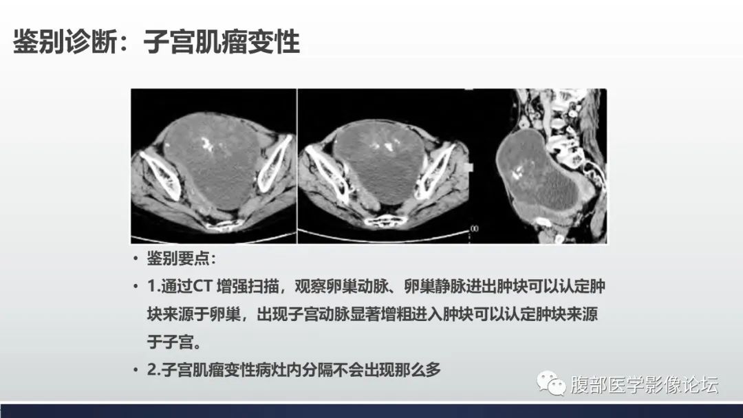 影像PPT - 【病例】卵巢颗粒细胞瘤3例影像-24