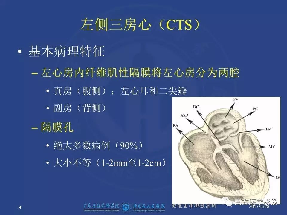 影像PPT - 【PPT】三房心（Cor triatiatum）-4