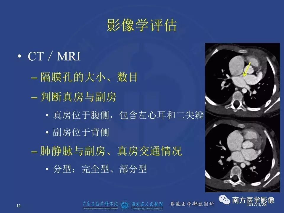 影像PPT - 【PPT】三房心（Cor triatiatum）-11