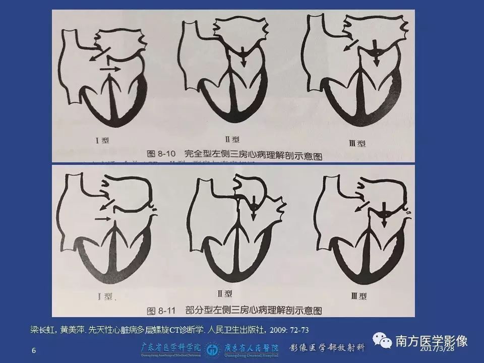影像PPT - 【PPT】三房心（Cor triatiatum）-6