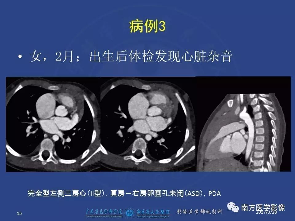 影像PPT - 【PPT】三房心（Cor triatiatum）-15