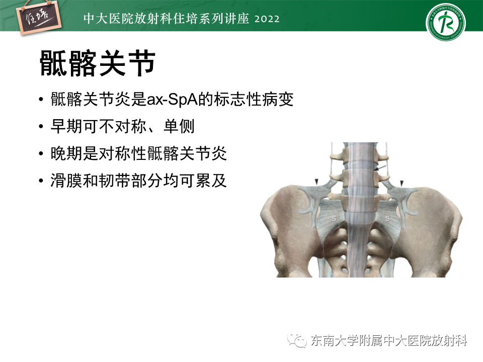 影像PPT - 【PPT】脊柱关节炎影像学评估-8