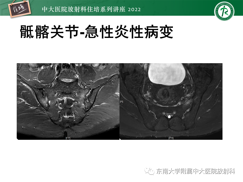 影像PPT - 【PPT】脊柱关节炎影像学评估-10