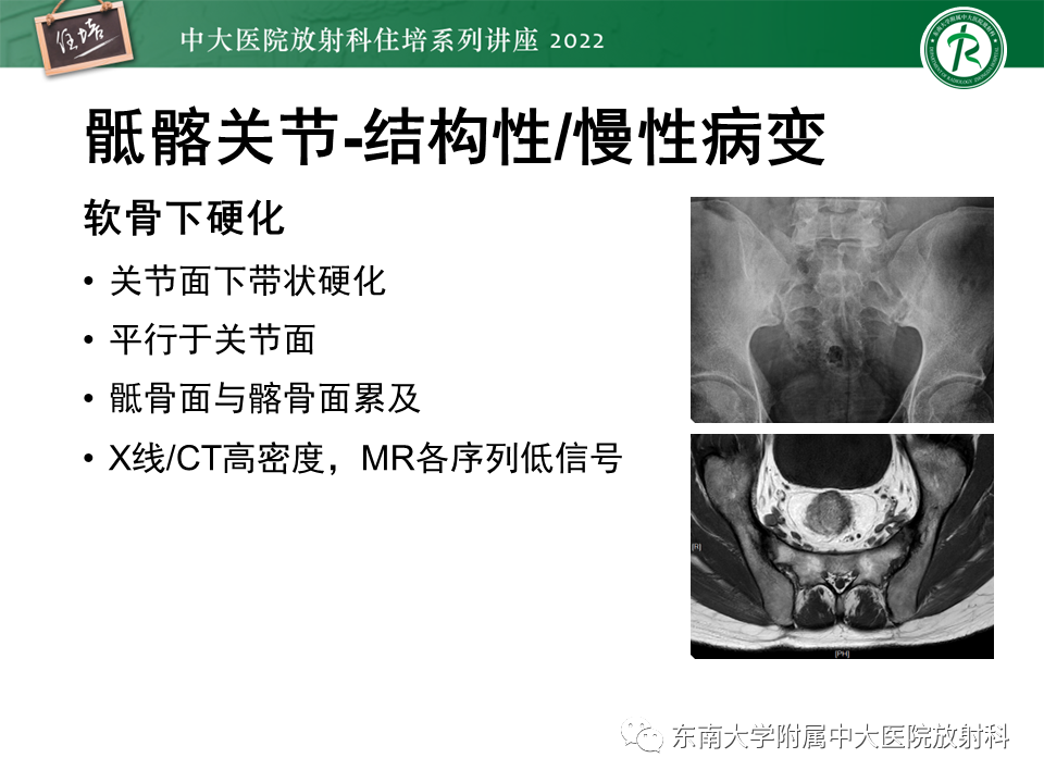 影像PPT - 【PPT】脊柱关节炎影像学评估-11