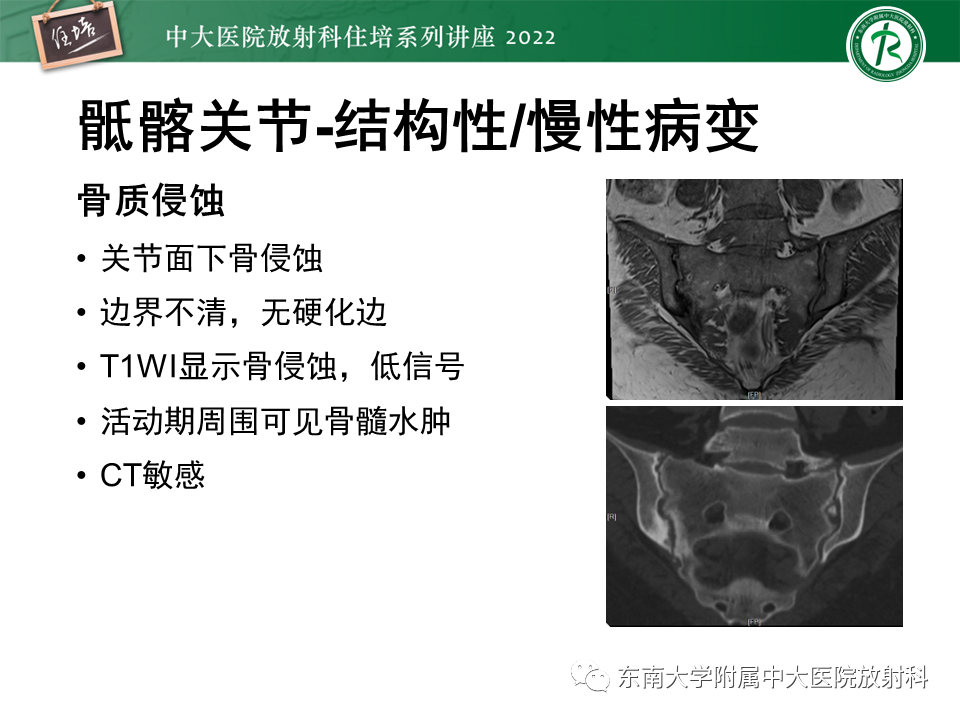 影像PPT - 【PPT】脊柱关节炎影像学评估-12