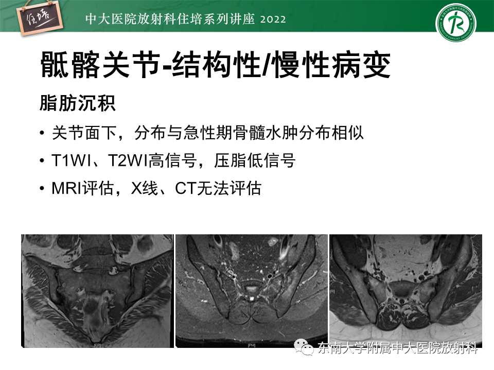 影像PPT - 【PPT】脊柱关节炎影像学评估-13