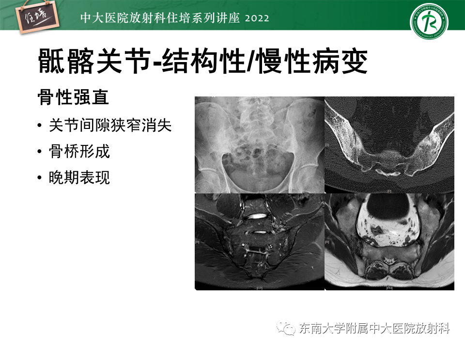 影像PPT - 【PPT】脊柱关节炎影像学评估-14