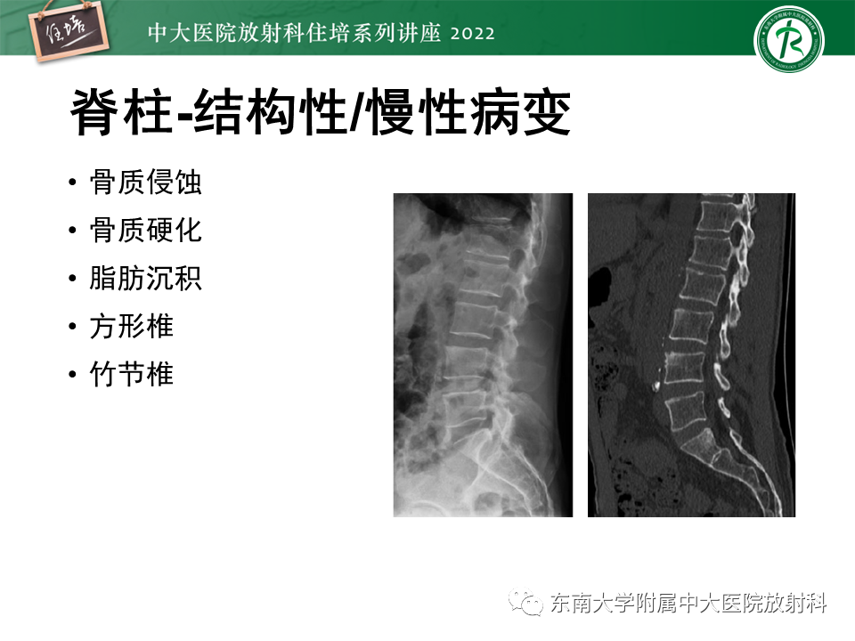 影像PPT - 【PPT】脊柱关节炎影像学评估-17