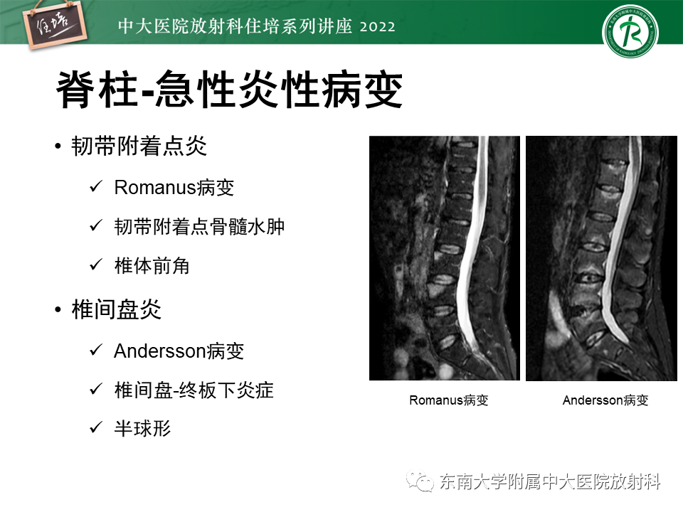 影像PPT - 【PPT】脊柱关节炎影像学评估-16