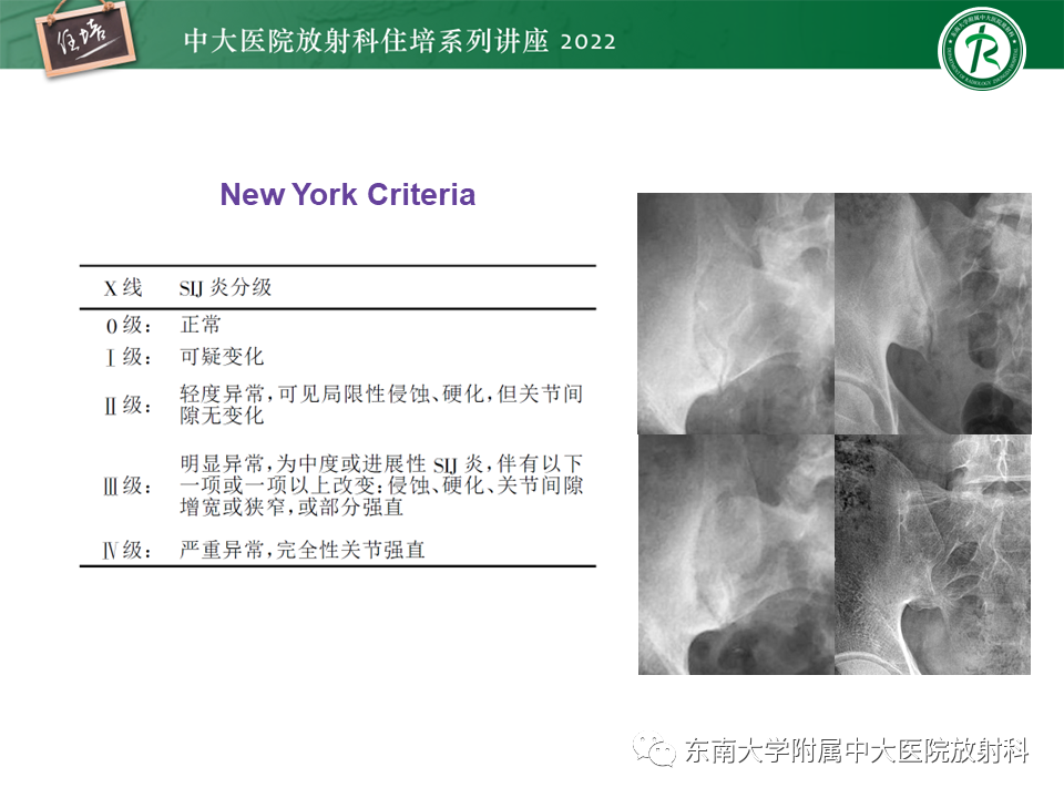 影像PPT - 【PPT】脊柱关节炎影像学评估-20