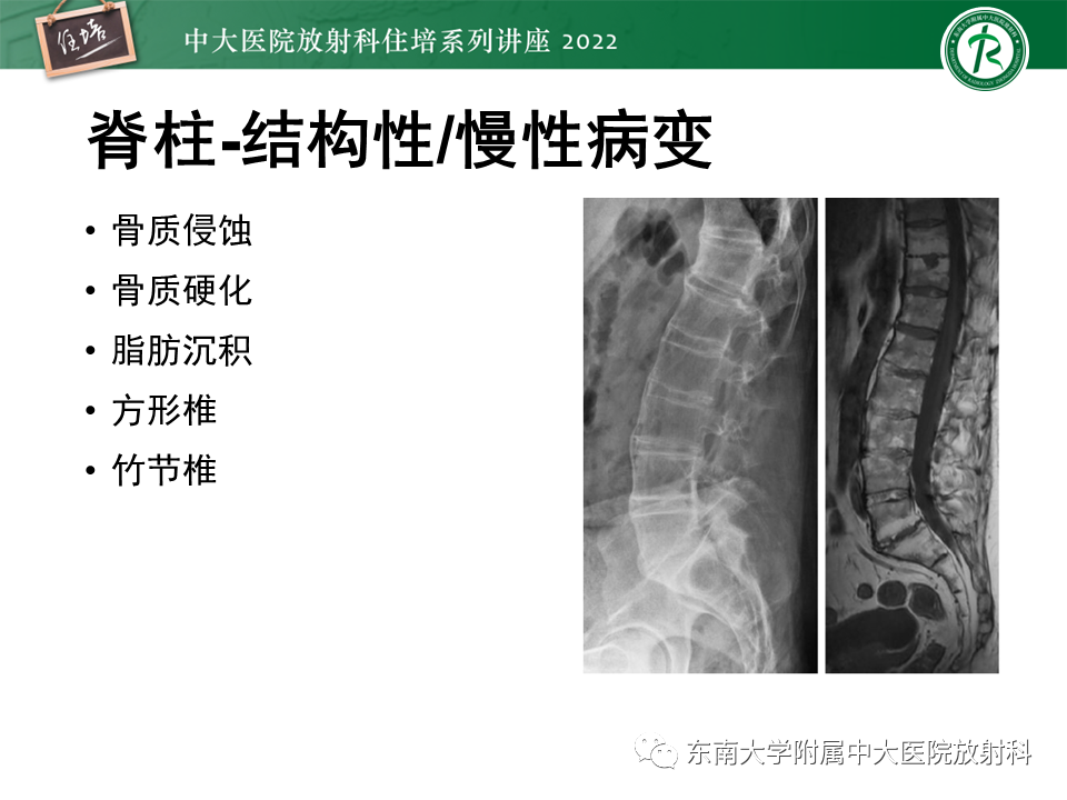 影像PPT - 【PPT】脊柱关节炎影像学评估-18