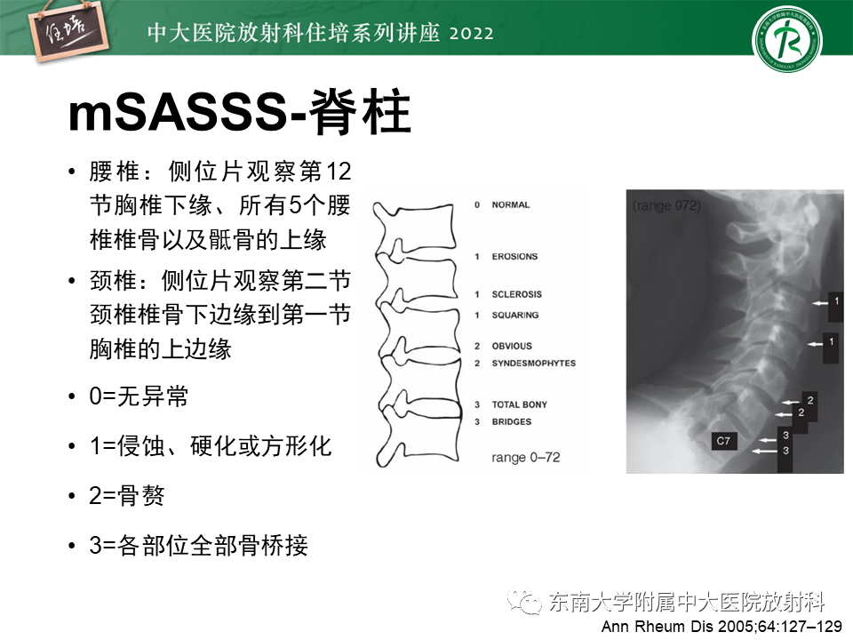 影像PPT - 【PPT】脊柱关节炎影像学评估-21