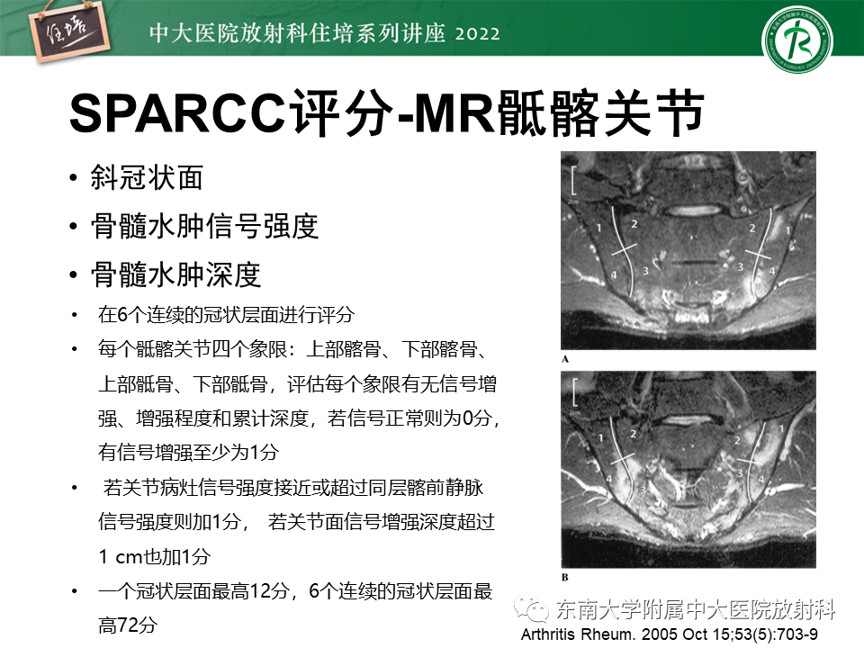 影像PPT - 【PPT】脊柱关节炎影像学评估-22