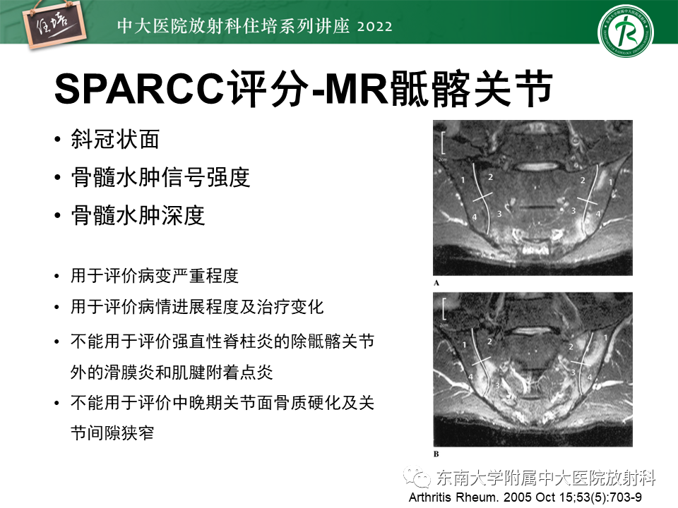 影像PPT - 【PPT】脊柱关节炎影像学评估-23