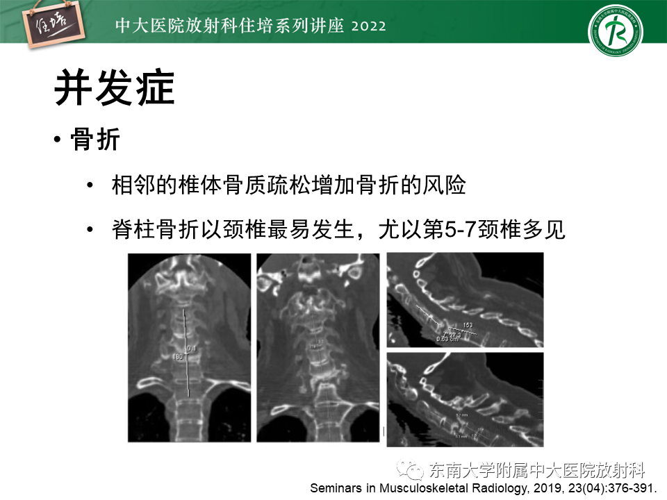 影像PPT - 【PPT】脊柱关节炎影像学评估-27