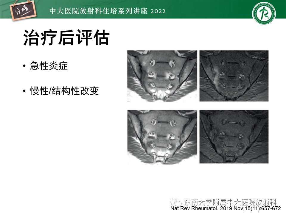 影像PPT - 【PPT】脊柱关节炎影像学评估-25