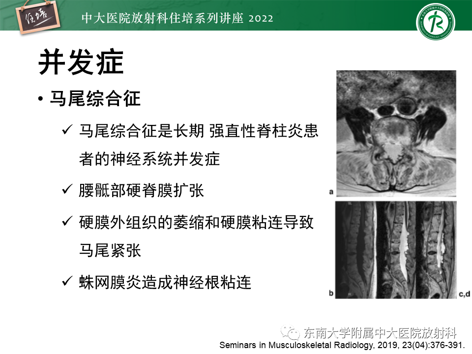 影像PPT - 【PPT】脊柱关节炎影像学评估-28