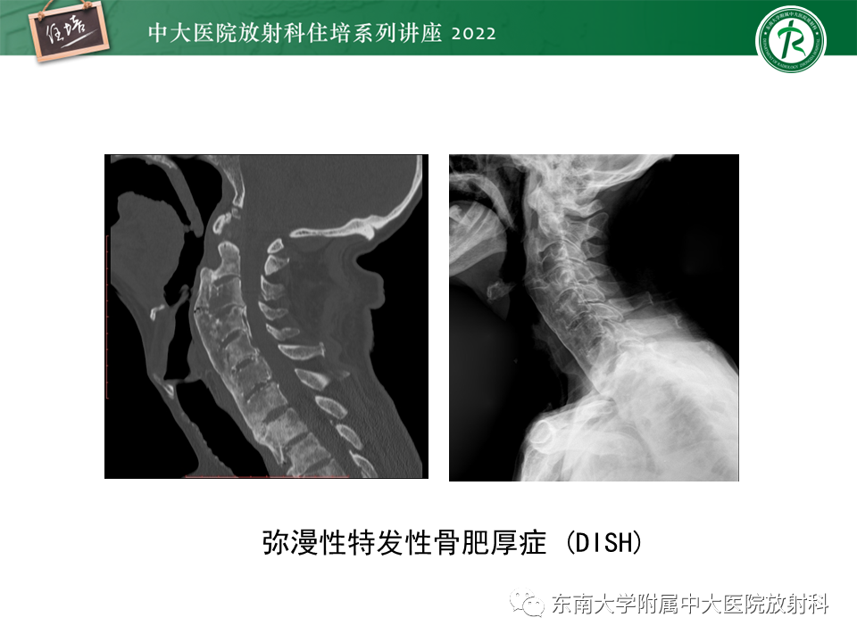 影像PPT - 【PPT】脊柱关节炎影像学评估-34
