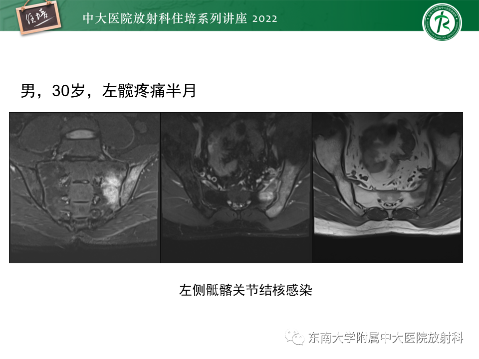 影像PPT - 【PPT】脊柱关节炎影像学评估-32