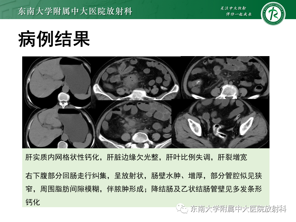 影像PPT - 【PPT】血吸虫肝病-2
