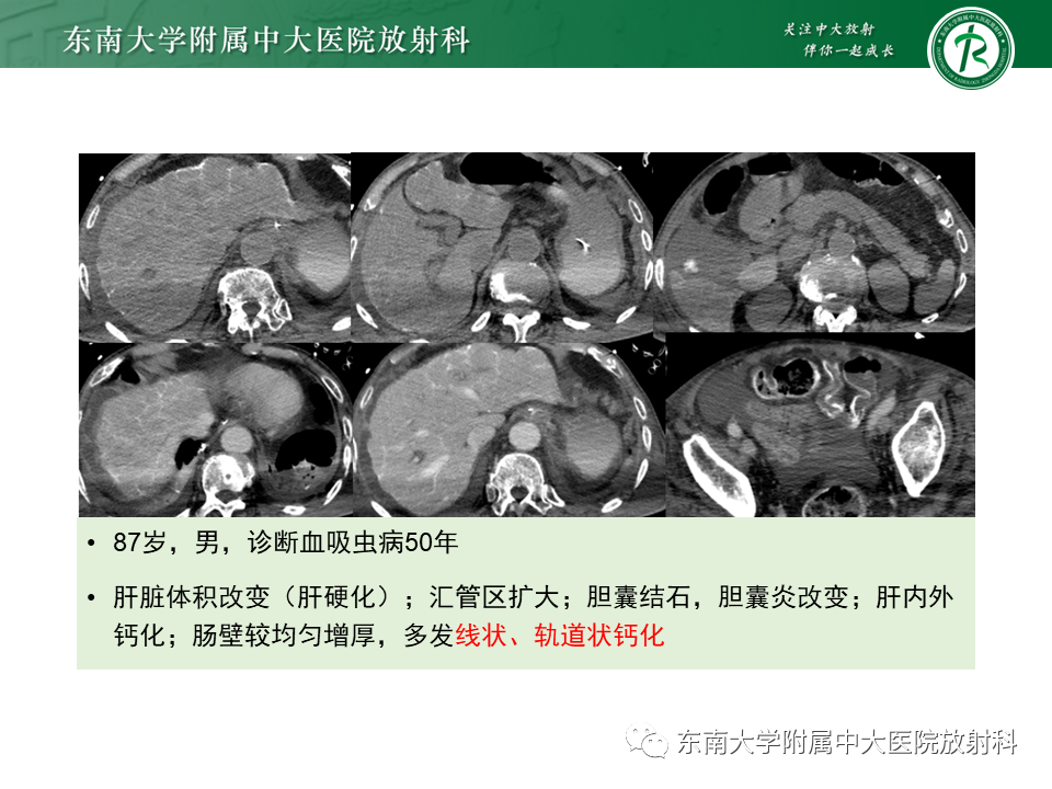影像PPT - 【PPT】血吸虫肝病-19