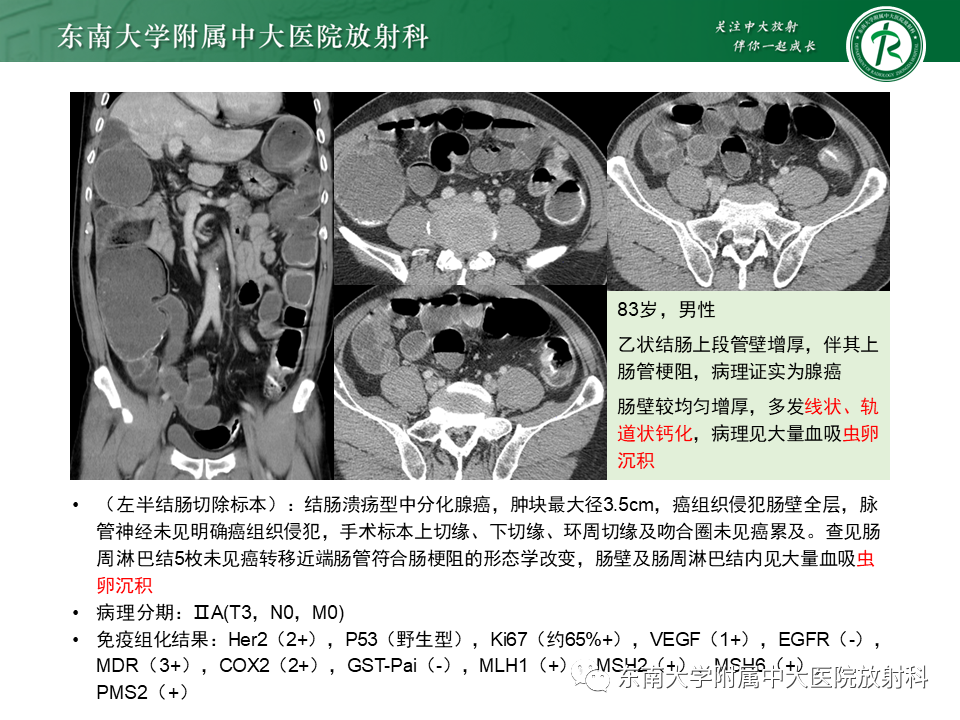 影像PPT - 【PPT】血吸虫肝病-22