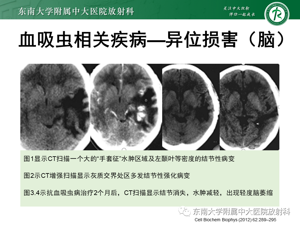 影像PPT - 【PPT】血吸虫肝病-28