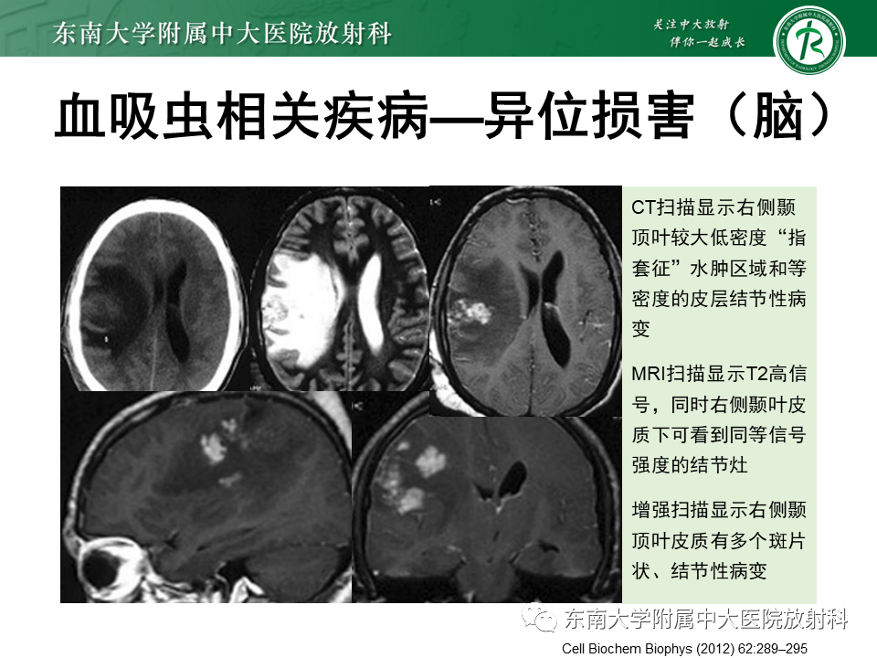 影像PPT - 【PPT】血吸虫肝病-27