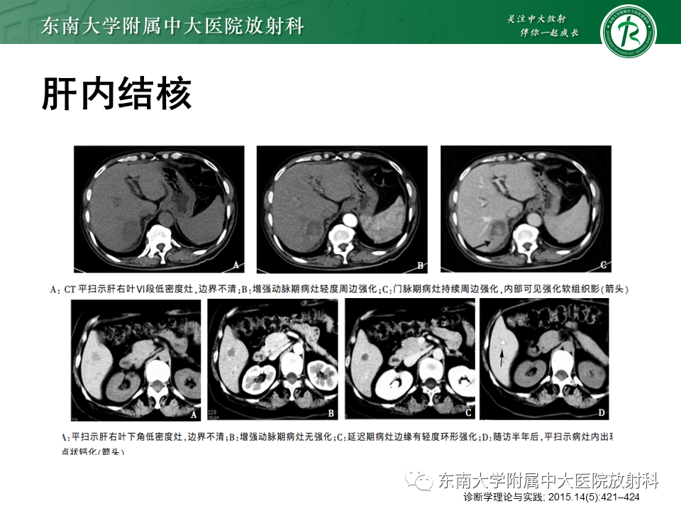 影像PPT - 【PPT】血吸虫肝病-32