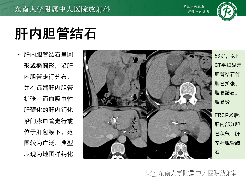 影像PPT - 【PPT】血吸虫肝病-33