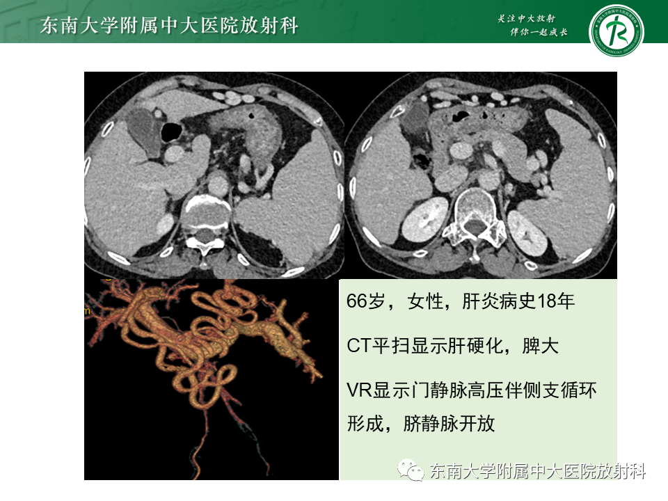 影像PPT - 【PPT】血吸虫肝病-35